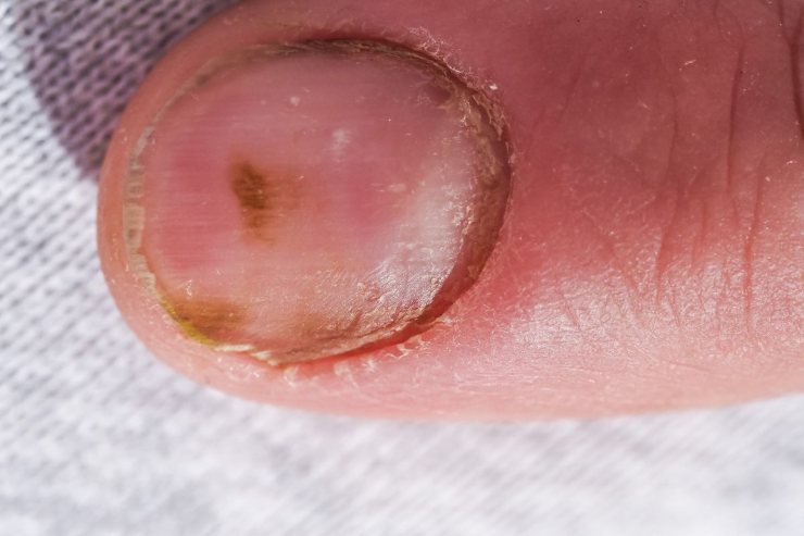 macchie unghie malattia grave