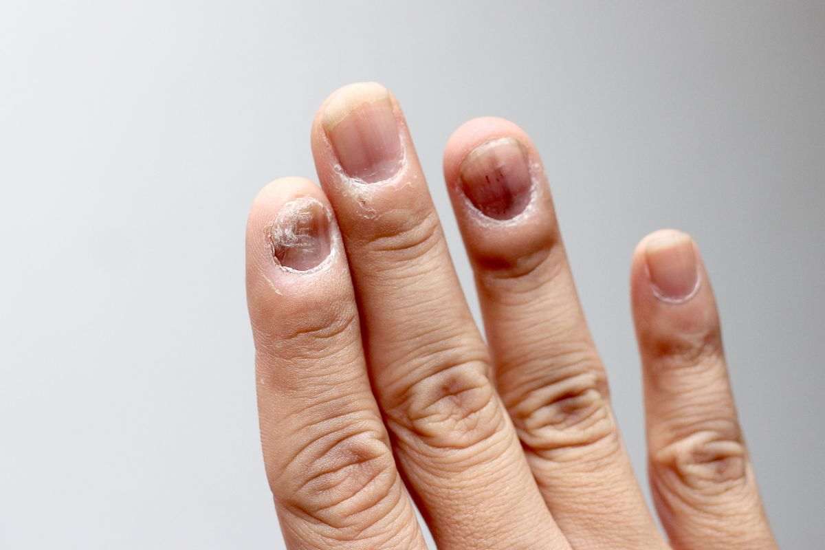 macchie unghie malattia grave